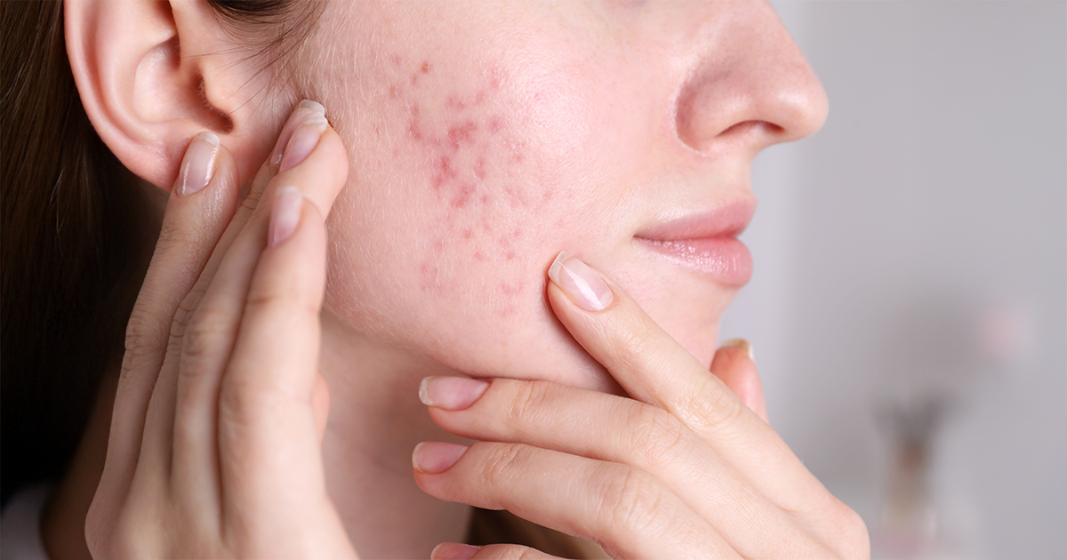 Acne during pregnancy
